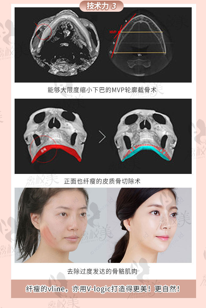 韩国id V-line手术.jpg?x-oss-process=style/lzmei