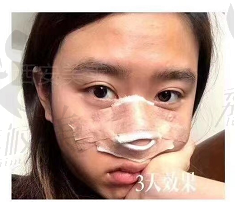 西安美莱隆鼻三天效果图