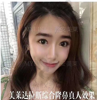 西安美莱隆鼻术后效果图
