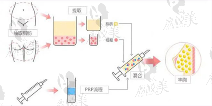 自體脂肪豐胸原理