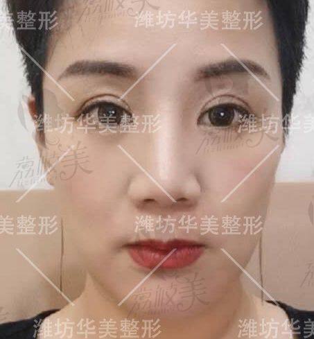 潍坊华美医疗整形美容医院五代黄金热玛吉案例