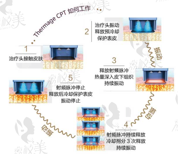 熱瑪吉工作原理