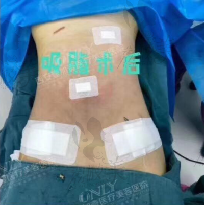 王俊河腰腹吸脂术后
