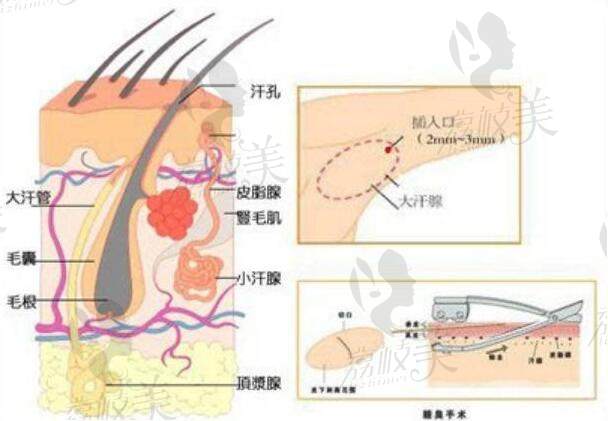 【去狐臭】 <span style=