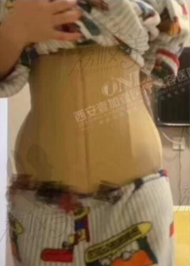 王俊河腰腹吸脂术后