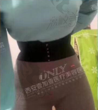 王俊河腰腹吸脂术后