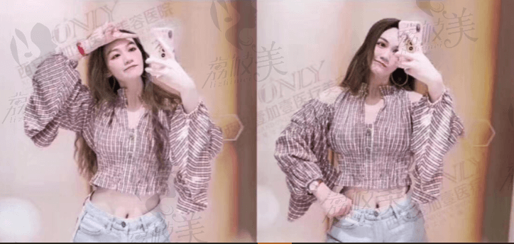 王俊河腰腹吸脂术后