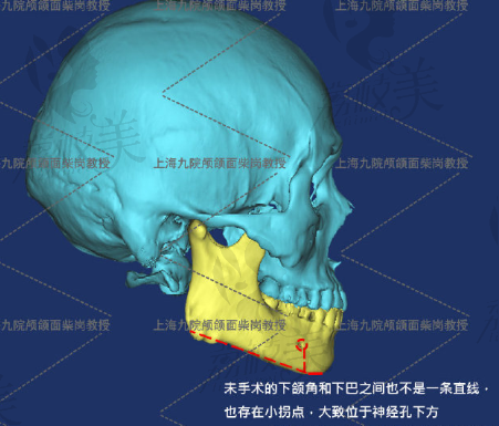 柴岗术前下颌角.png?x-oss-process=style/lzmei