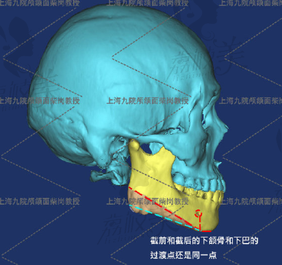 柴岗下巴夹角案例.png?x-oss-process=style/lzmei