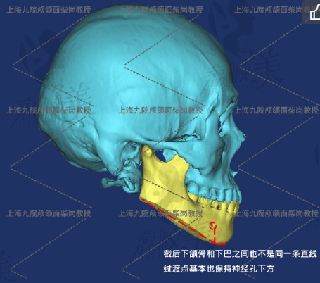 柴岗下颌角案例.png?x-oss-process=style/lzmei