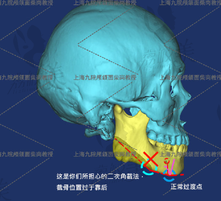 柴岗下颌角二次留角.png?x-oss-process=style/lzmei
