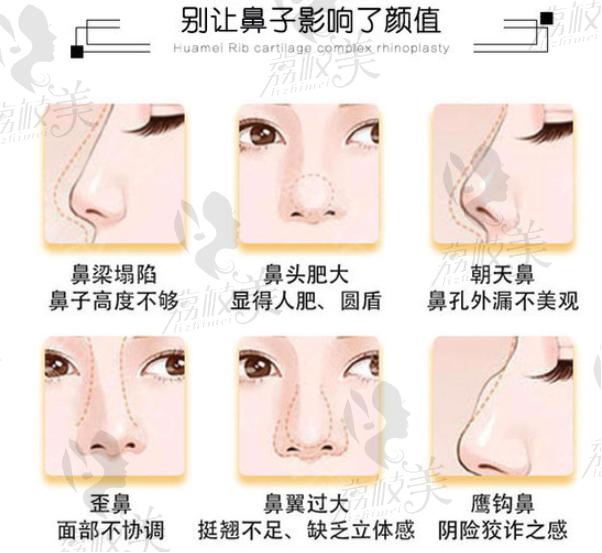 别让鼻子影响了颜值，鼻子出现的多种问题