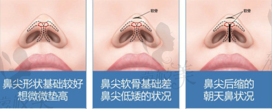 鼻尖整形手术方法