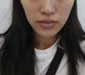 西安美莱 嘴角上扬手术案例