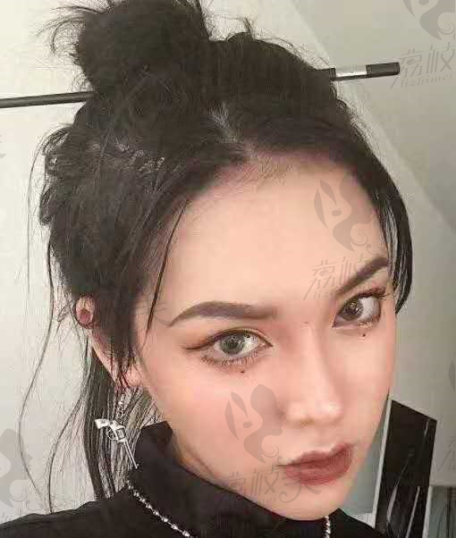 西安美莱 嘴角上扬手术案例