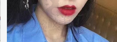 西安美莱 嘴角上扬手术案例