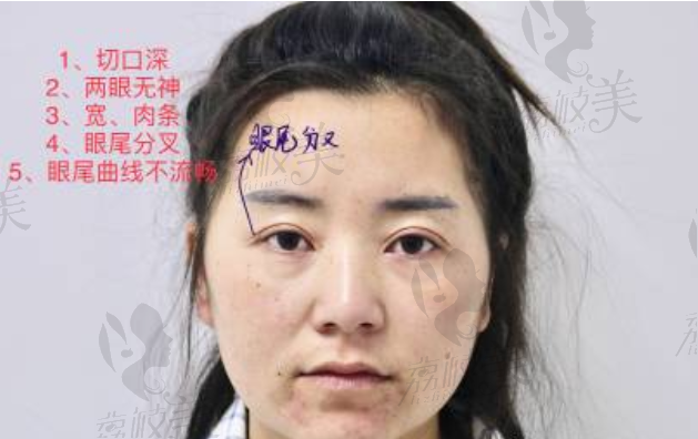 北京东方百合王世勇双眼皮修复案例分享