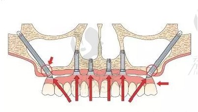 全口牙齿缺失，重度牙周病，种植牙做穿颧穿翼风险大吗？