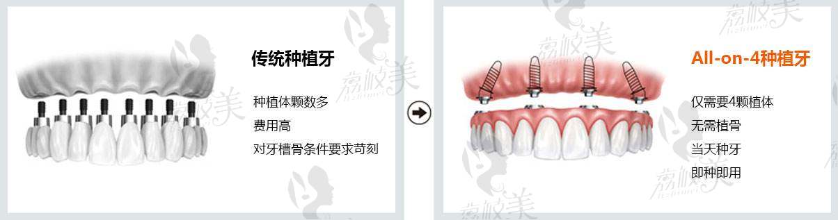 西安海涛口腔种植牙价格