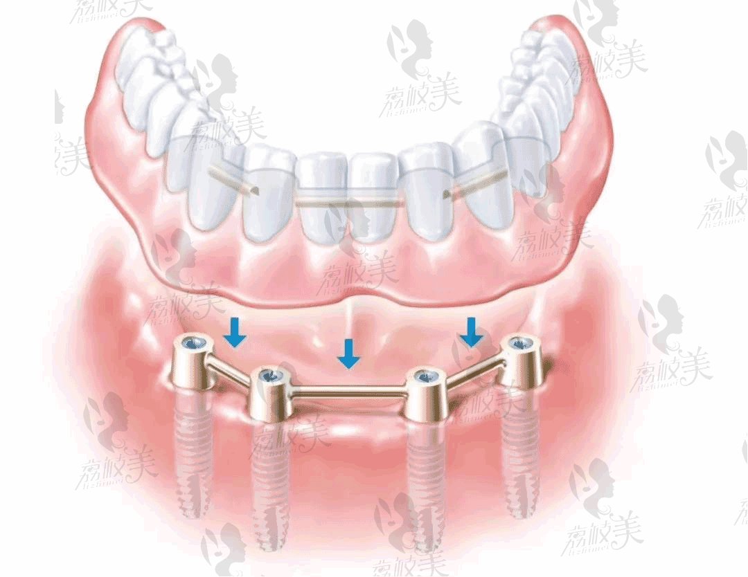 西安海涛口腔赵海涛院长All-on-4种植牙价格