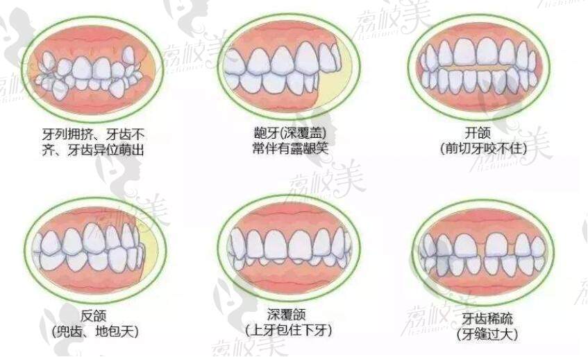 牙齿矫正问题