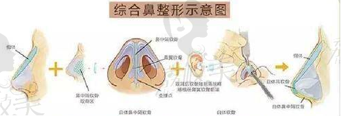 鼻综合流程