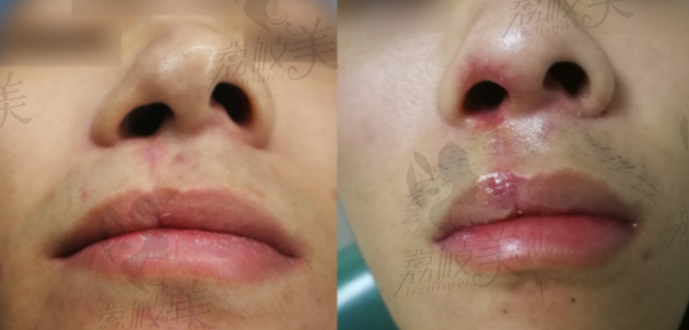 唇腭裂1期成年后鼻畸形修复案例