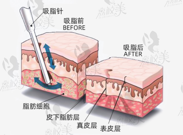 上海仁愛(ài)醫(yī)院吸脂原理