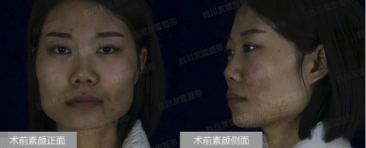 四川友谊医院张立天面部轮廓手术，术前照片。