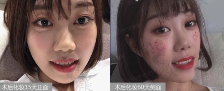 四川友谊医院张立天面部轮廓术后15天和60天后的照片，效果非常满意。