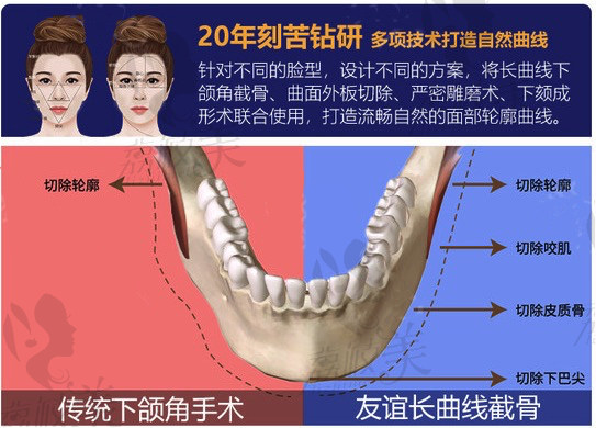 四川省友誼醫(yī)院的長(zhǎng)曲線下頜角截骨術(shù)和其他醫(yī)院截骨技術(shù)的區(qū)別