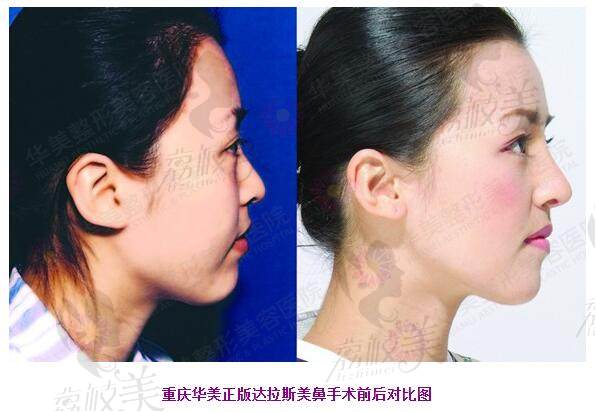 重庆华美正版美鼻手术前后对比图