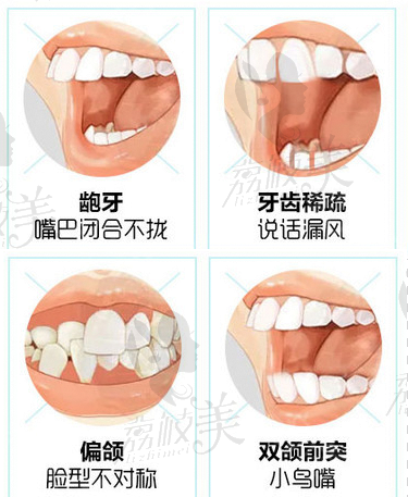可以通过矫正改善的四种牙齿情况