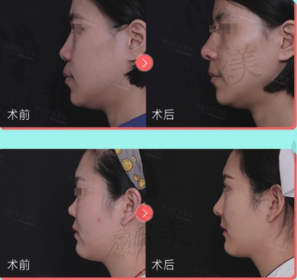 北京沃尔鼻整形案例