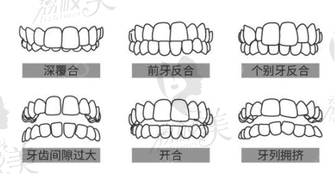 隱適美牙齒隱形矯正