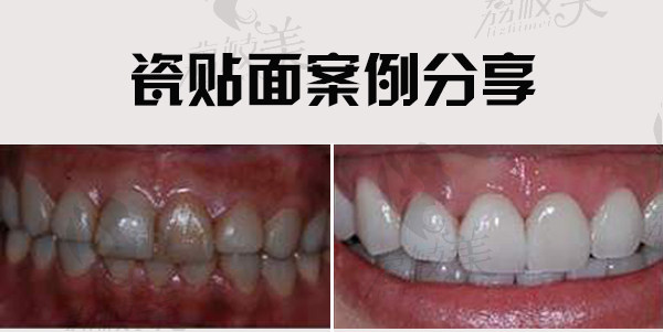 杭州维多利亚口腔医院的洪超医生瓷贴面案例分享