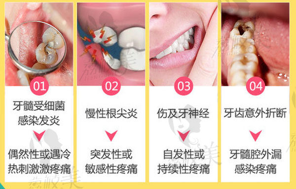 哪些牙齿需要做根管治疗