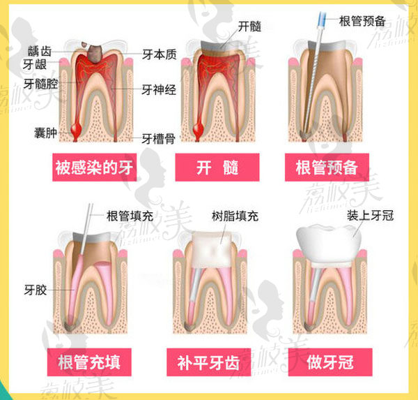 根管治疗标准化流程