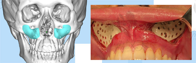 华西口腔医院罗恩教授3d骨打印填充面中部骨质凹陷过程图