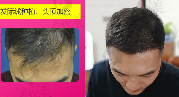 广州华美植发医院男士发际线+头顶加密种植案例