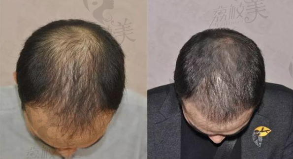 广州雅度植发中心男士植发四个月案例