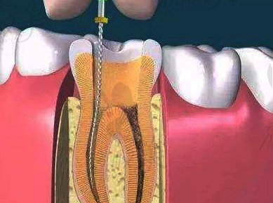 江苏根管治疗