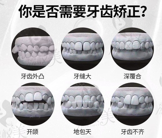 你是否需要牙齿矫正?你有以下症状吗？1.牙齿外凸  2.牙缝大  3.深覆合  4.开颌  5.地包天  6.牙齿不齐