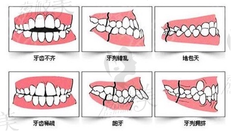 深圳美奥口腔经典金属托槽矫正的适应人群有哪些？