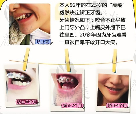 深圳美奥口腔魏虹森主任经典金属托槽矫正案例分享