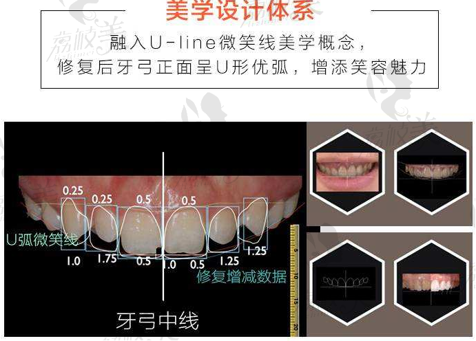 门牙美学笑线修复体系