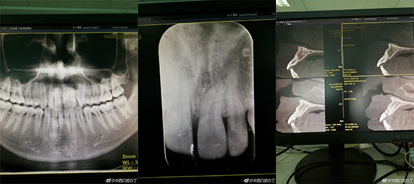 乳牙受伤长大后恒牙骨穿孔ct检查图