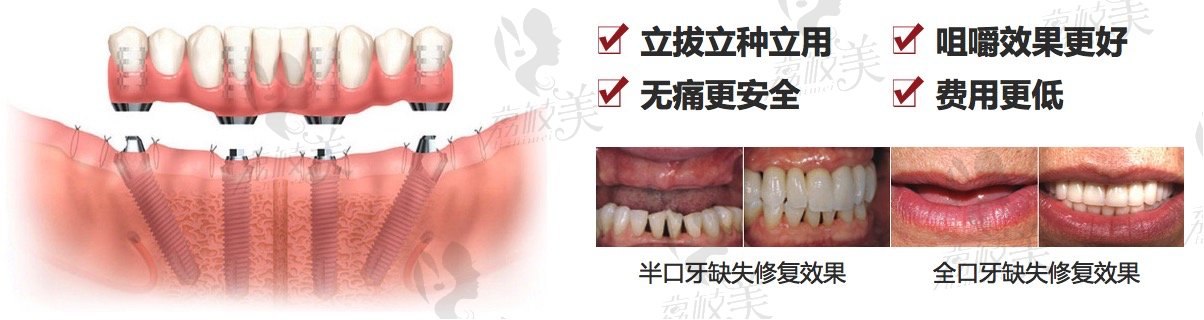 杭州口腔医院平海院区院长王维倩院长牙齿种植案例分享