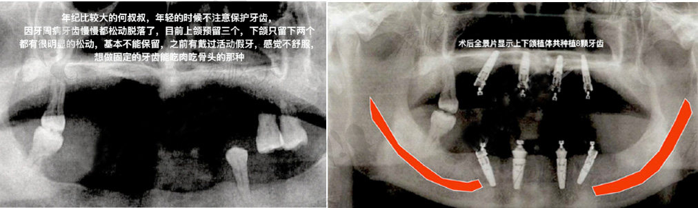 华西口腔宫萍高难度all-0n-4全口种植牙案例前后ct对比