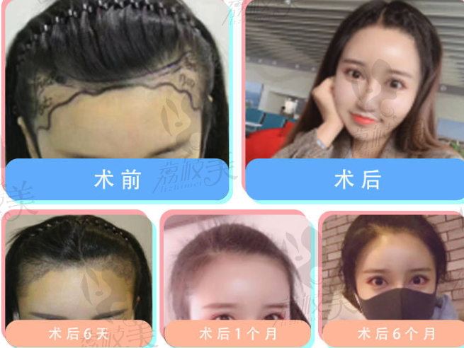 北京新面孔种植发际线案例